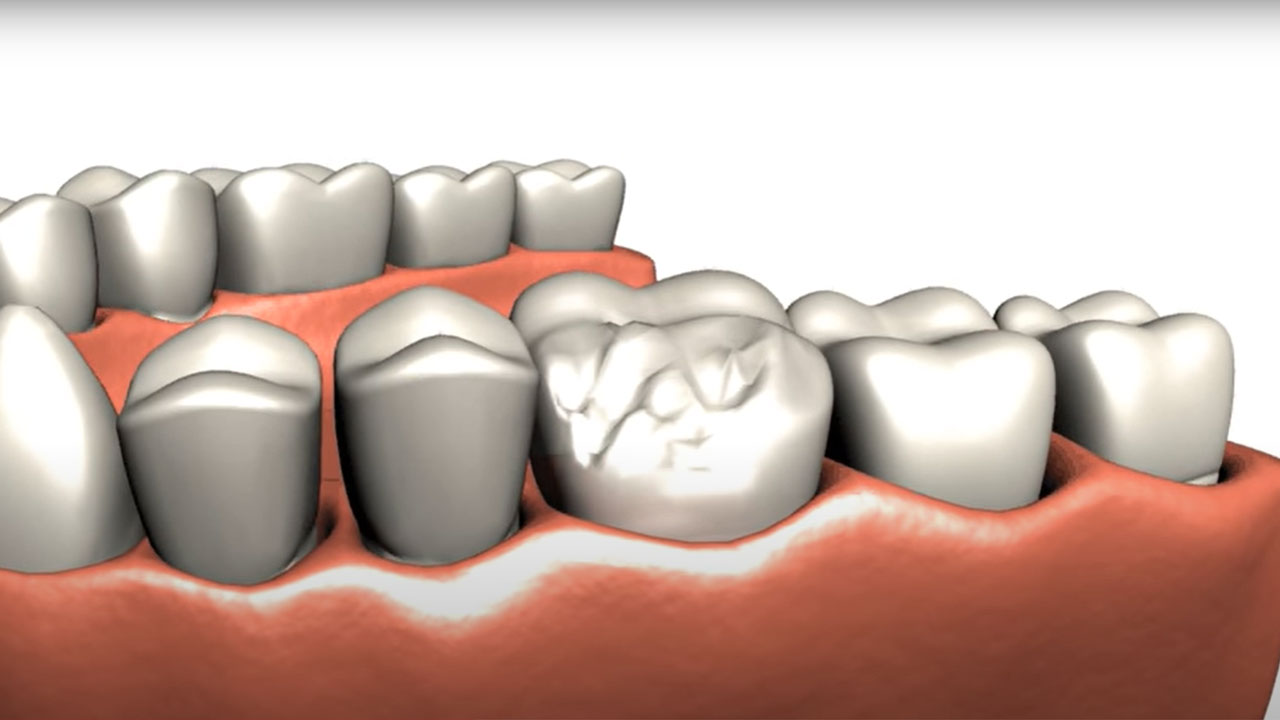 Dental Crowns