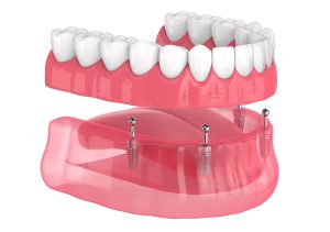 The five steps required for placing all-on-4 full-mouth dental implants for complete tooth replacement