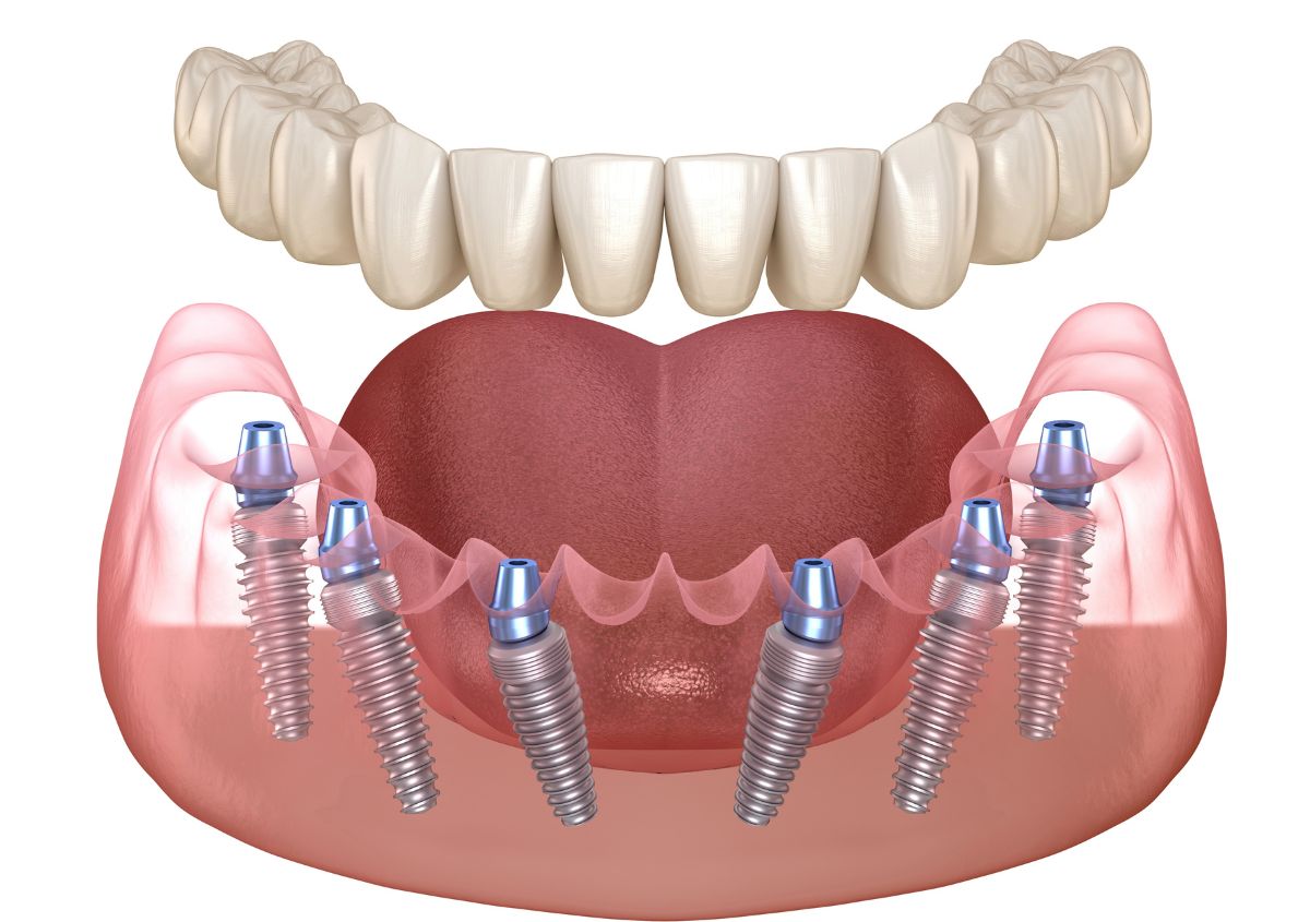Burley’s Guide to Implant-Supported Dentures: 6 Things You Should Know
