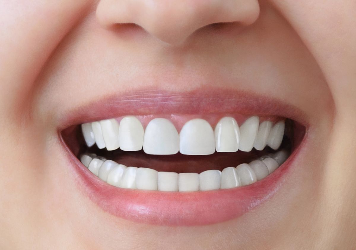 Natural-Looking Tooth Fillings: Everything You Need to Know at Seasons Dental in Burley, ID