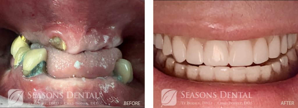 Dentures and Dental Implants before and after results Chrome Case near Burley, ID