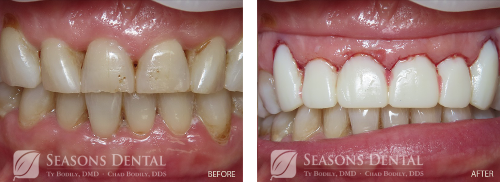 Dentures and Dental Implants before and after results Full Upper Arch Reconstruction near Burley, ID