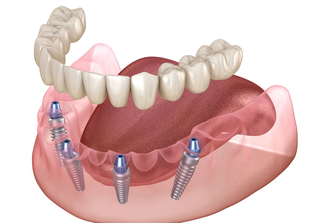 Reconstructing Your Smile? 7 Reasons to Choose Implant Dentures
