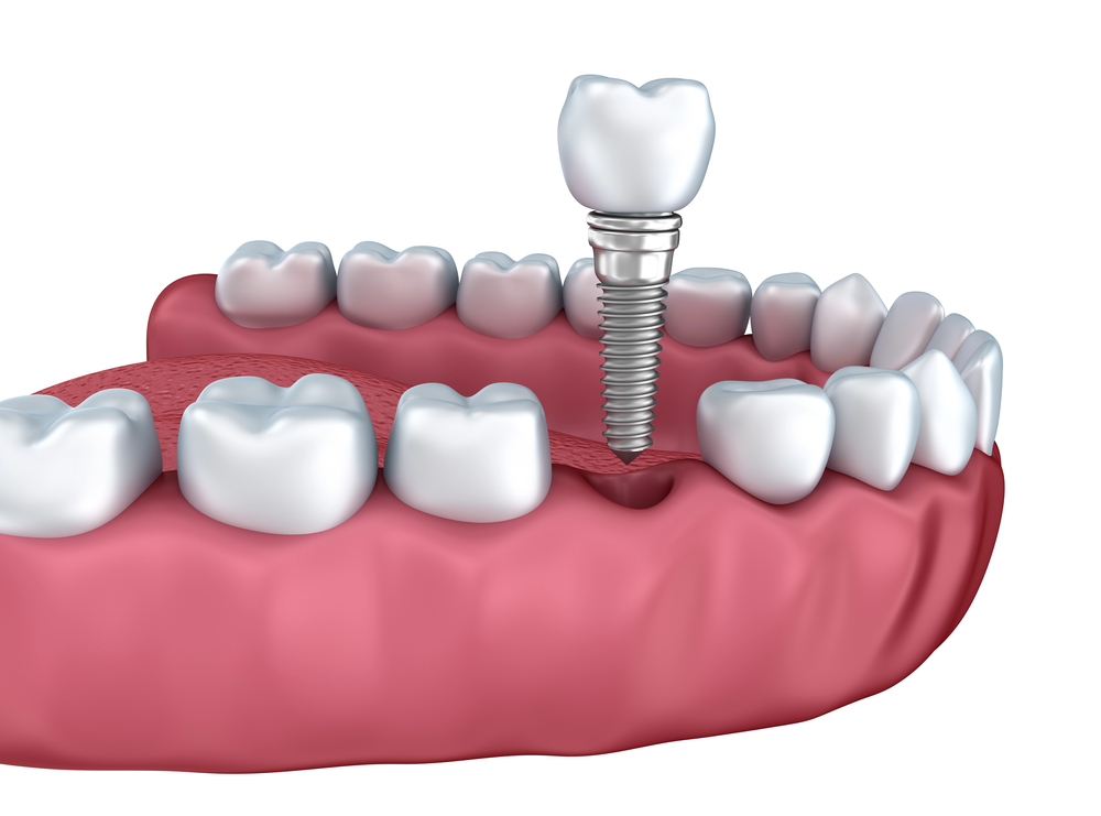 Dental Implants with Seasons Dental