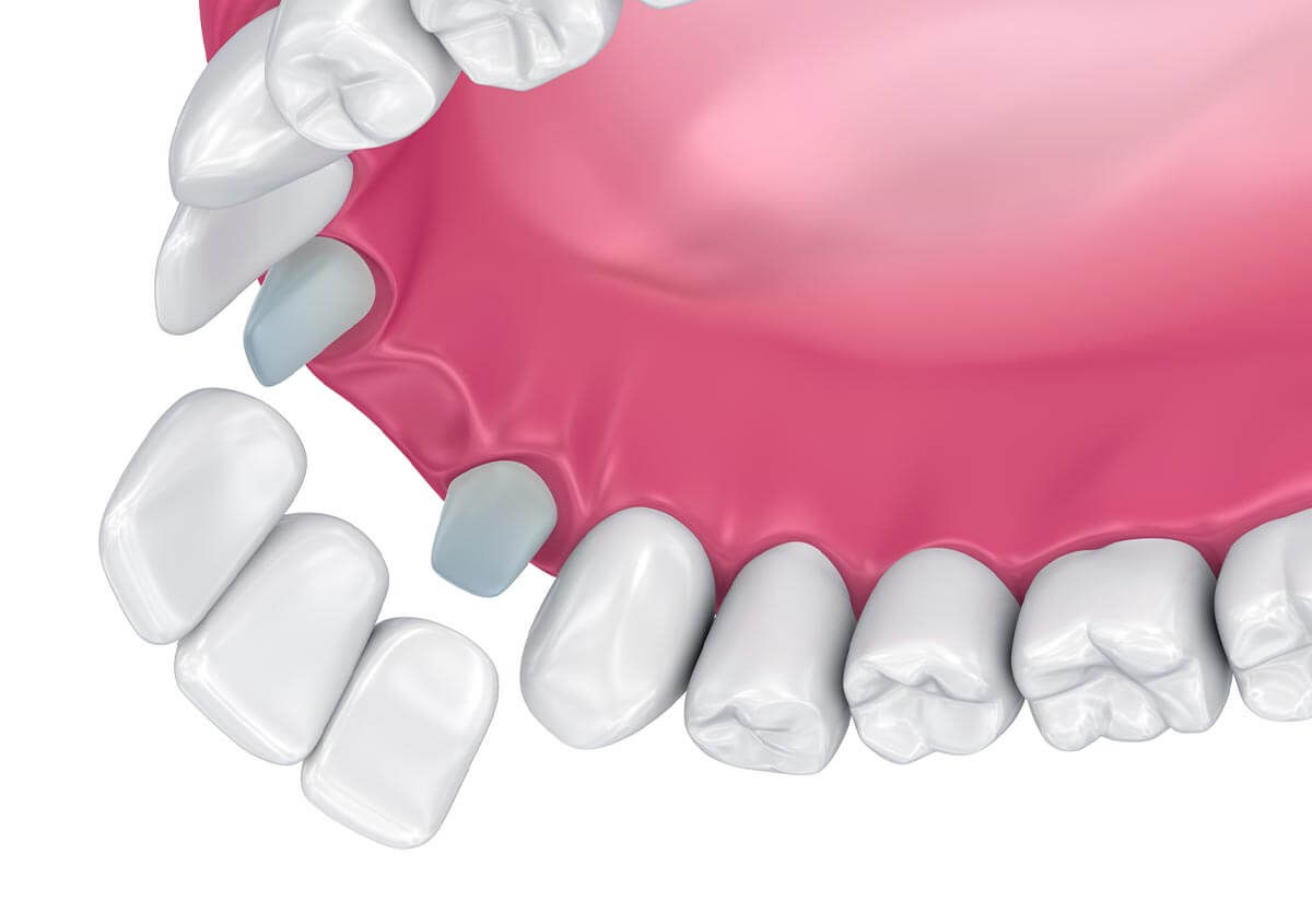 Dental Bridge Repair in Burley ID Area