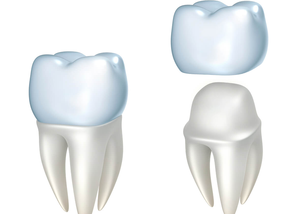 Yes, you really can get a dental crown in one visit!