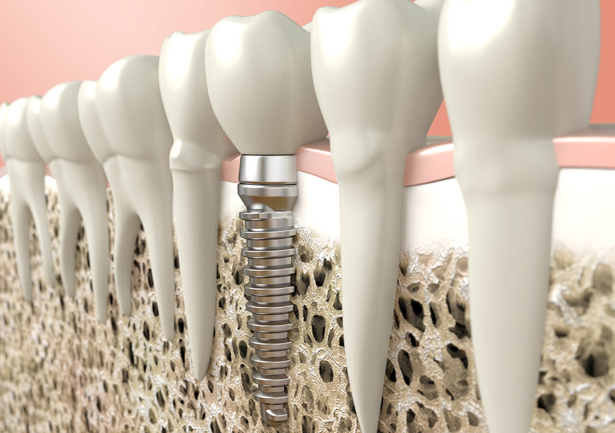 Dental Implant vs. Crown: 5 Ways They Differ and When Each Is the Better Choice