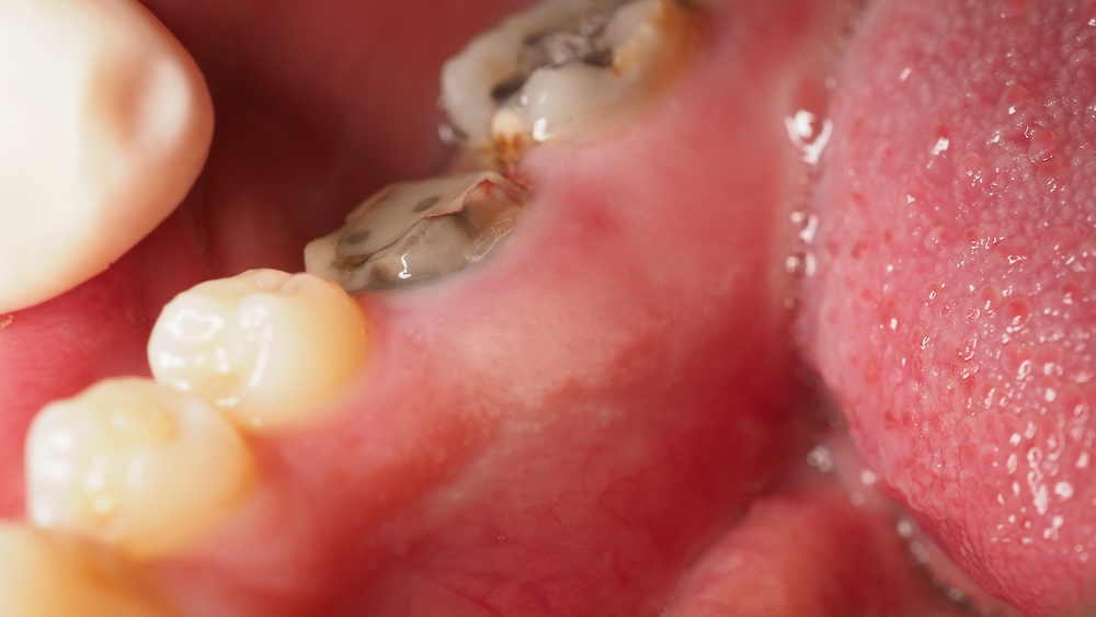 a person with a rotten tooth