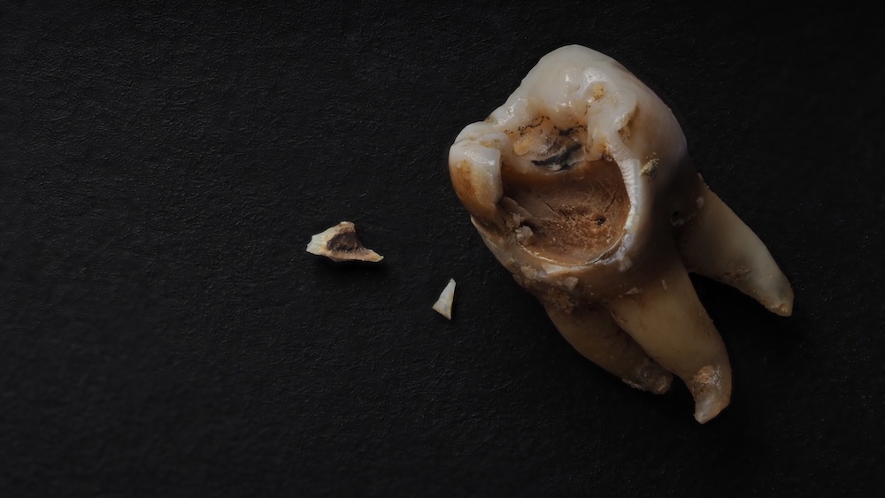 a broken tooth